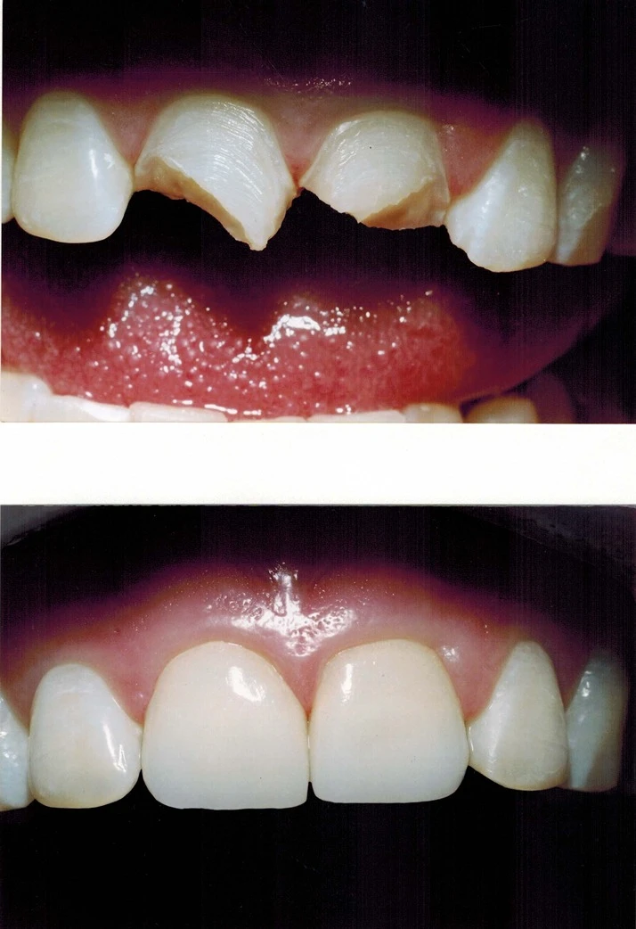 Dentist Elmhurst IL Broken Tooth