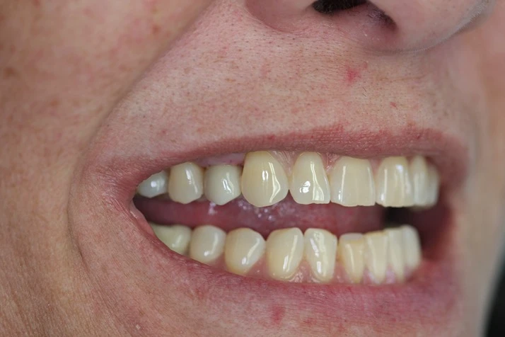 Dentist Elmhurst IL Dental Implants 2