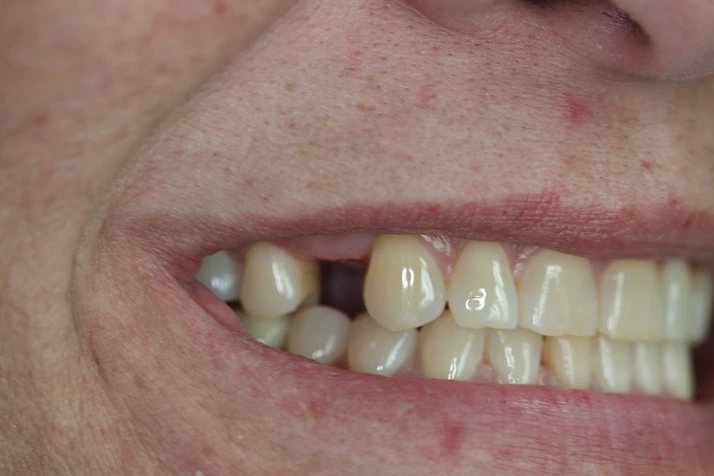 Dentist Elmhurst IL Dental Implants