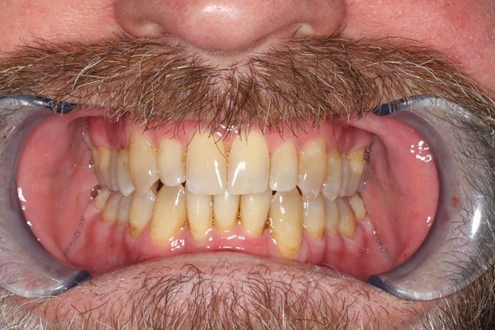 Dentist Elmhurst IL Invisalign 2