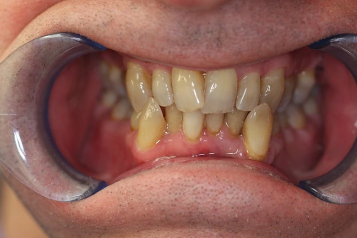 Dentist Elmhurst IL Invisalign