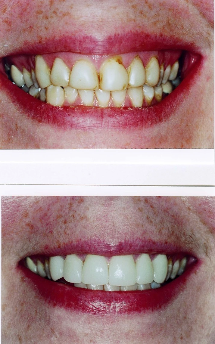 Dentist Elmhurst IL Porcelain Dental Veneers