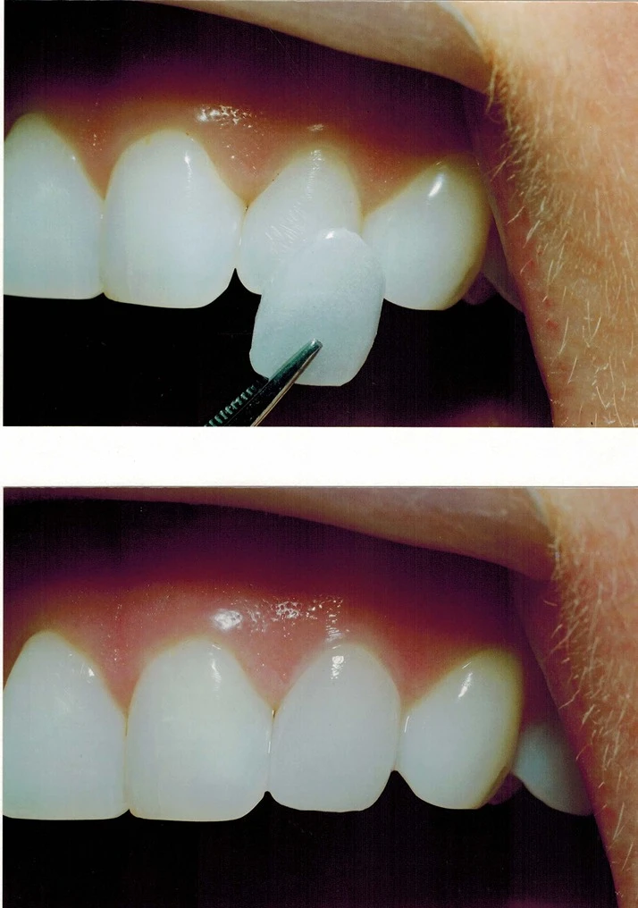 Dentist Elmhurst IL Veneers